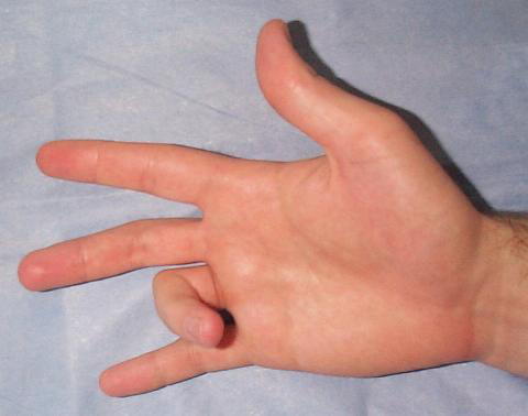 Болезнь Нотта или «щёлкающий палец»
