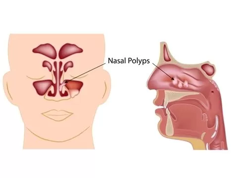 Полипы в носу - причины, симптомы, диагностика, лечение (операция по удалению)
